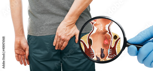 Proctologist's hand with a magnifying glass shows the pathology of rectum and hemorrhoids close-up. Over background, man with hemorrhoid disease photo