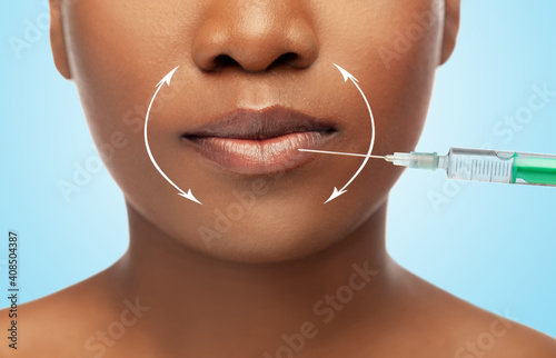 beauty  plastic surgery and people concept - close up of face of beautiful young african american woman and syringe with hyaluronal injection for lips augmentation over blue background