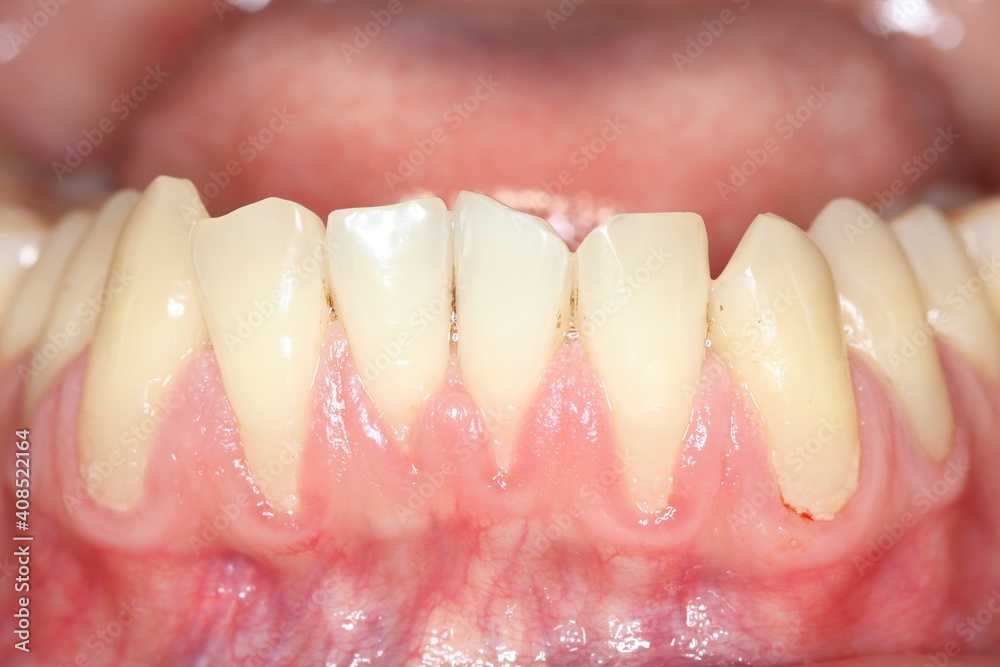Gingival recession, also known as receding gums, is the exposure in the