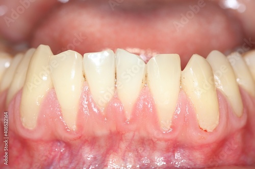 Gingival recession, also known as receding gums, is the exposure in the roots of the teeth caused by a loss of gum tissue and/or retraction of the gingival margin from the crown of the teeth. photo