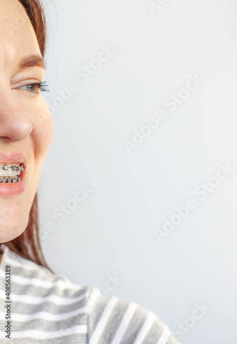 Braces in the smiling mouth of a girl. Smooth teeth from braces.