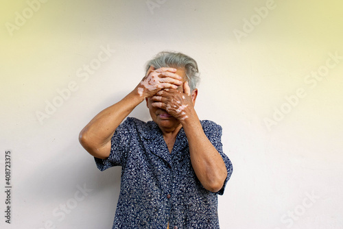 The old woman with vitiligo on her hand