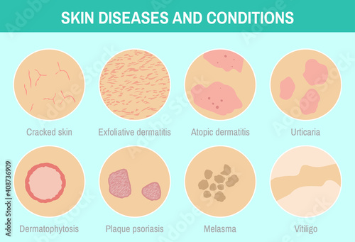 Vector illustration "Skin diseases and conditions". 8 circle images set. Skin with different disorders. Colorful infographic for medical articles, posters and banners.