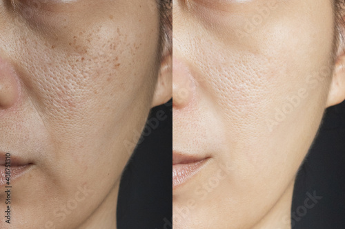 two pictures compare effect Before and After treatment. skin with problems of freckles , pore , dull skin and wrinkles before and after treatment to solve skin problem for better skin result