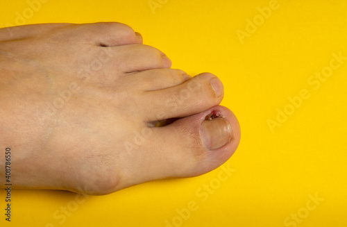 Vászonkép Ingrown nail or purulent onychocryptosis