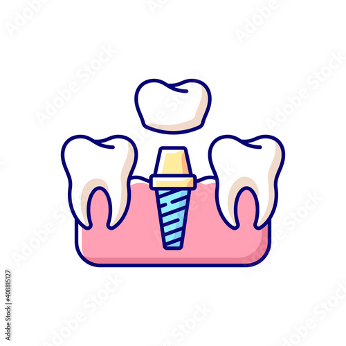 Dental implants procedure RGB color icon. Professional stomatology poccupation. Tooth recovery process. Dental surgety. Proffesional cosmetics stomatology. Isolated vector illustration