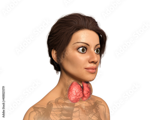 Hyperthyroidism, Graves' disease photo