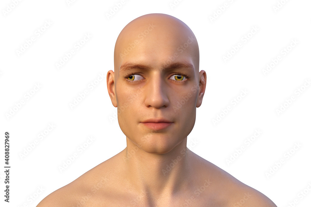 Strabismus, eyes deviation, illustration Strabismus, eyes deviation, illustration