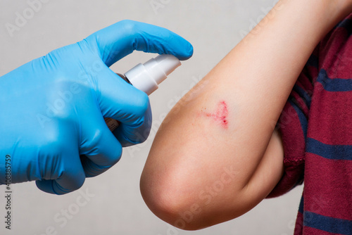 Doctors hand sprays an antiseptic agent on the wound on the childs hand. Treatment the wound. First Aid