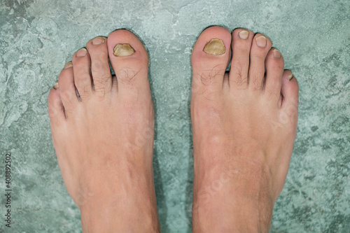 Young man barefoot fingers with sick onycho mycosis nails,dermatologic medical illness,health problem 