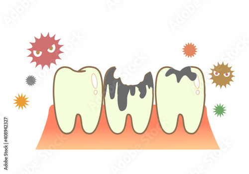 illustrations of dental sealants treatment before after