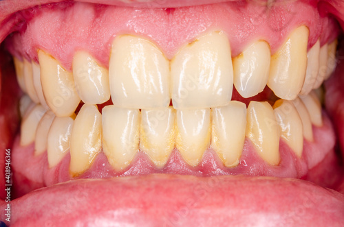 close up of teeth with gingivitis and dental plaque