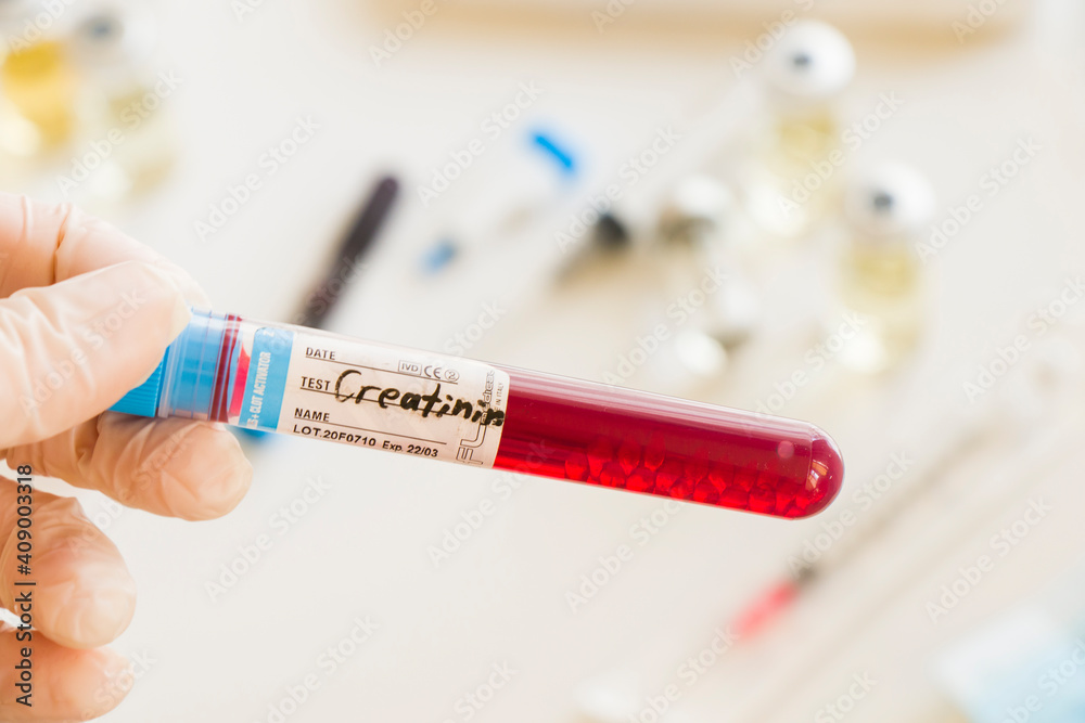 Fototapeta premium Creatinine blood test tube sample in doctors hand in laboratory