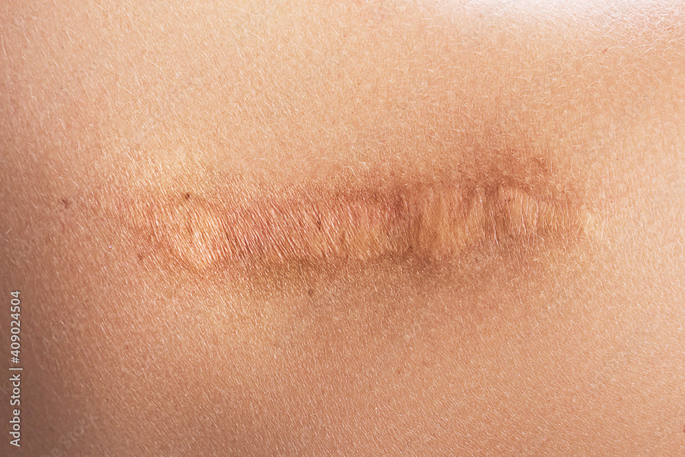 Fototapeta premium Female shoulder with a scar after surgery