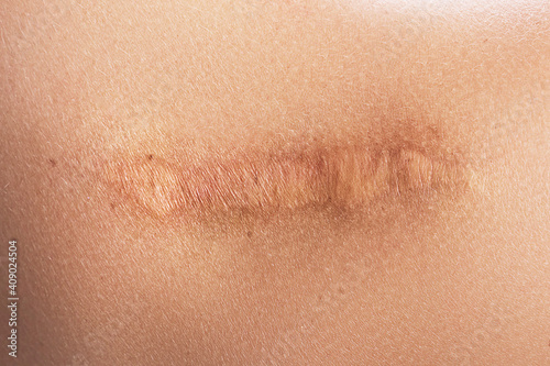 Female shoulder with a scar after surgery