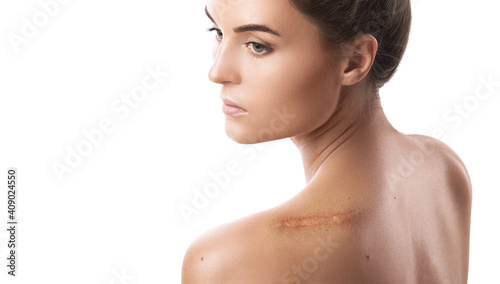 Young woman with a scar on her shoulder