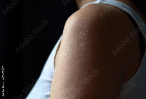 closeup of a young woman vaccine scar on the left upper arm
