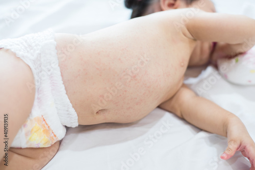 Tapet baby rash skin, prickly heat on baby (selective focus)