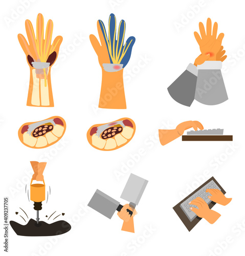 Carpal tunnel syndrome. Cause by repetitive hand movement until tissue inflame and compress on nerve. medical and healthcare concept.