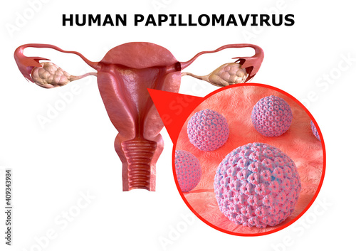 human papillomavirus or HPV, is a sexually transmitted infection. It causes warts on the skin and in the oral, anal and genital regions