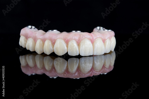 Quality dental prosthesis made of titanium beam and ceramics for fixation to the upper jaw. Teeth treatment.