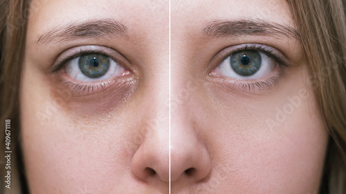 Cropped shot of a young female face. Female green eyes with bruises under eyes before and after cosmetic treatment. Dark circles under the eyes