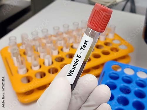 Biochemist or Lab Technologist holds Blood samples for Vitamin E or Tocopherol test, fat-soluble compound which is need for prevent different type of disease. Medical or health concept. photo