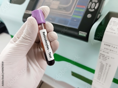 Biochemist or Doctor holds Blood samples for Reticulocyte Count test. Immature Red Blood Cell (RBC) analysis in hematology. Test in the laboratory background.