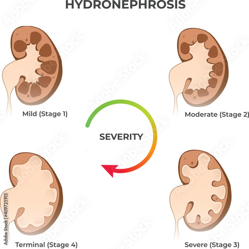 Four stages of kidney hydronephrosis. Vector illustration of the mild, moderate, severe, and terminal kidney disease