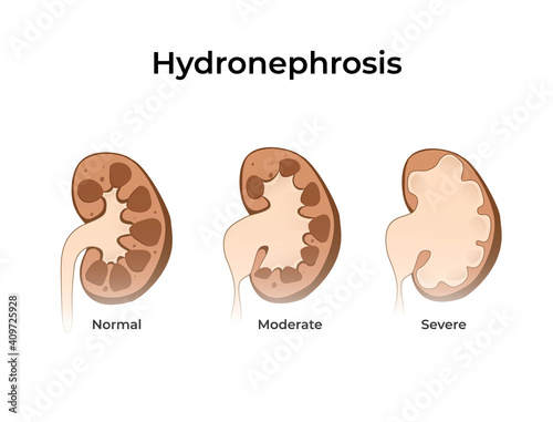 Normal kidney with hydronephrosis. Vector illustration of the of the kidney anatomy with dilated kidneys