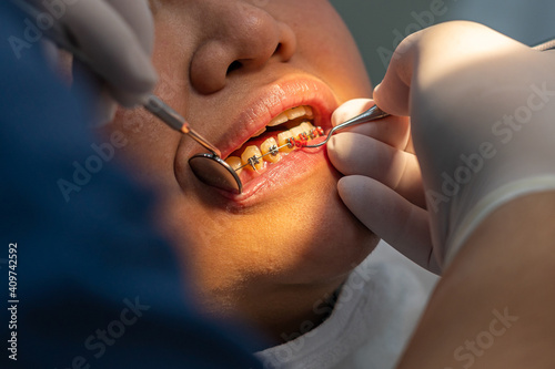 Close up photo of orthodontist checking up teeth braces for the girl © Quang