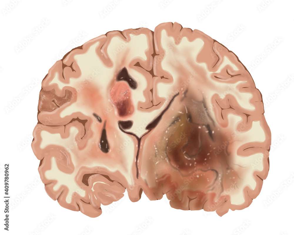 Brain tumor cross-section illustration Brain tumor cross-section illustration