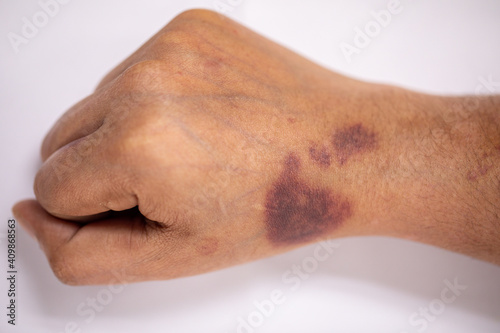 The physical appearance of the arm with the wound is caused by Haemophilia, (Haemophiliais a mostly inherited genetic disorder)