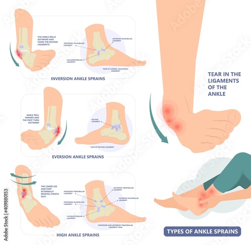 injury Talo Fibular foot treat high low roll twist tear tough bands bone joint range of motion Pain foot broken leg fall jump Walking exercising sport R.I.C.E rice Rest Ice break tendon Grade fibers
