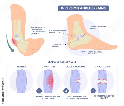 injury Talo Fibular foot treat high low roll twist tear tough bands bone joint range of motion Pain foot broken leg fall jump Walking exercising sport R.I.C.E rice Rest Ice break tendon Grade fibers