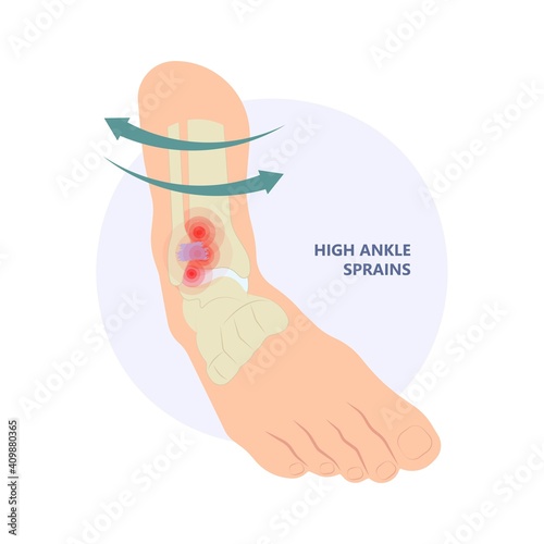 injury Talo Fibular foot treat high low roll twist tear tough bands bone joint range of motion Pain foot broken leg fall jump Walking exercising sport R.I.C.E rice Rest Ice break tendon Grade fibers