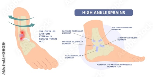 injury Talo Fibular foot treat high low roll twist tear tough bands bone joint range of motion Pain foot broken leg fall jump Walking exercising sport R.I.C.E rice Rest Ice break tendon Grade fibers