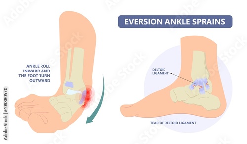 injury Talo Fibular foot treat high low roll twist tear tough bands bone joint range of motion Pain foot broken leg fall jump Walking exercising sport R.I.C.E rice Rest Ice break tendon Grade fibers