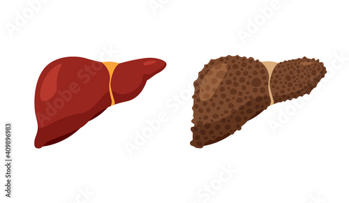 Fatty livers disease. Unhealthy sick liver and strong healthy liver. Digestive system anatomy. Fibrosis and cirrhosis. Vector illustration isolated on white background.