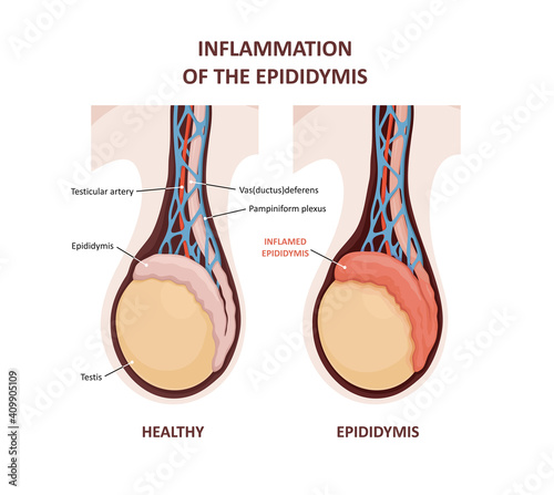 Epididymitis is inflammation of the epididymis of the testicle.