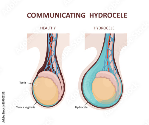 Communicating hydrocele. Testicular disease. Male reproductive system. photo