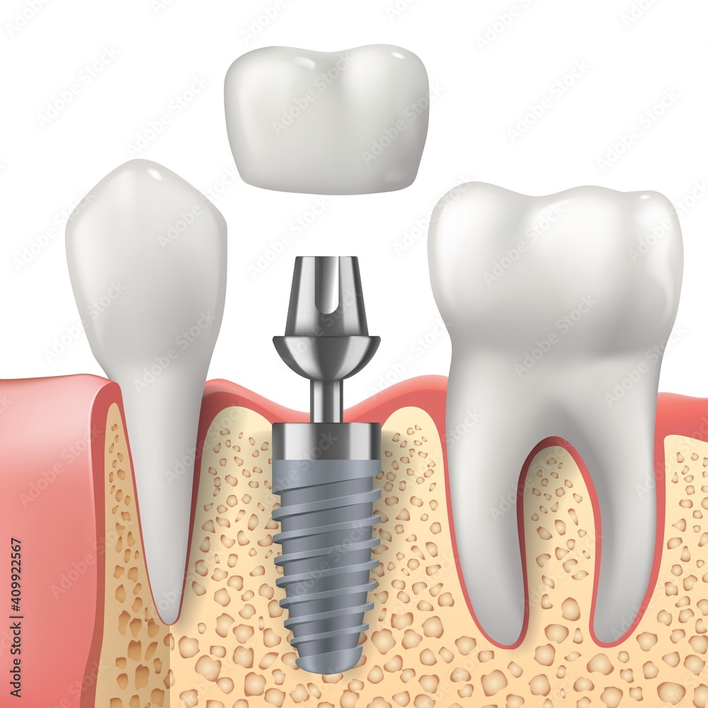 Teeth and dental implant realistic vector design of dentistry. 3d tooth