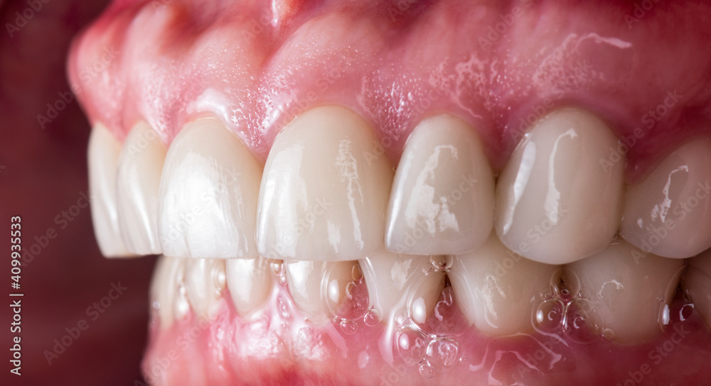 Obraz premium Emax press ceramic crowns and venners