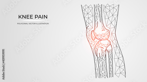 Polygonal vector illustration of pain, inflammation or injury in the knee side view. Human leg bones anatomy. Medical orthopedic diseases templates.