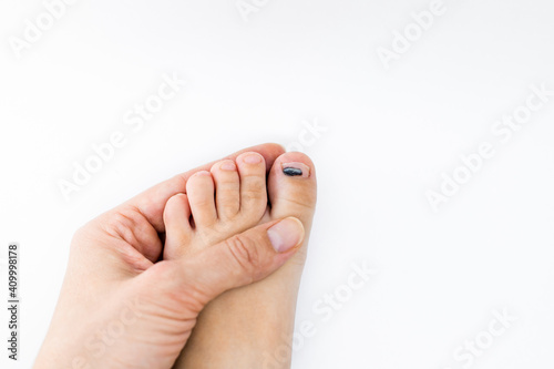 Hematoma under the fingernail of the child's toe