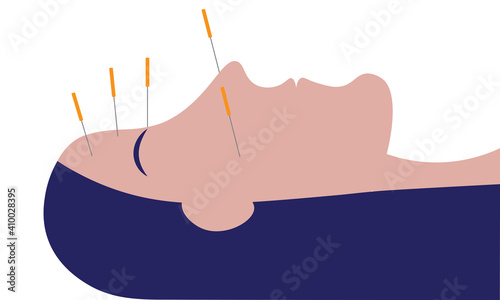 Acupuncture on a woman's face - Alternative therapy for migraine