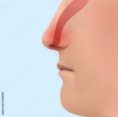 Nasal spray advertisement poster. Illustration of person, focus on nose