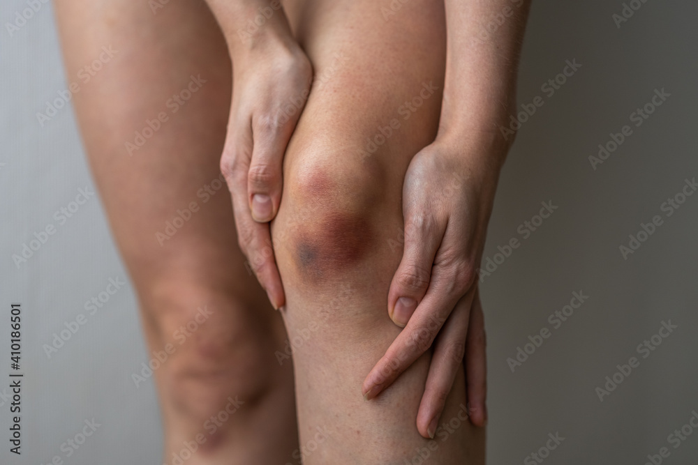 Bruise on the knee Bruise on the knee