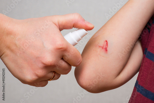 Womans hand sprays an antiseptic agent on the wound on the childs hand. Treatment the wound. First Aid