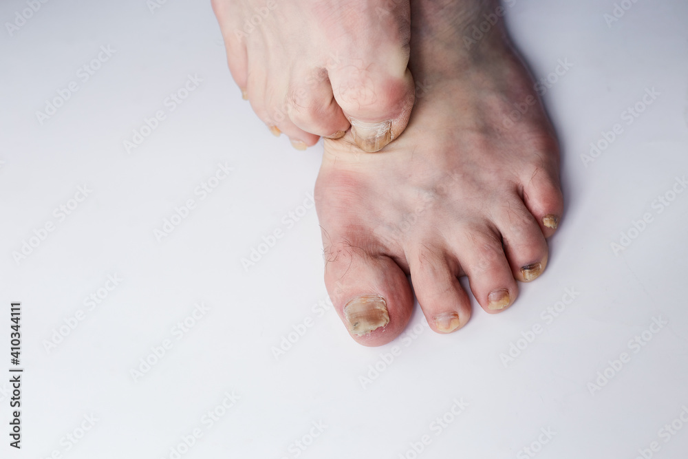 Nail fungus on legs disease. Fungal infection on nails legs, finger